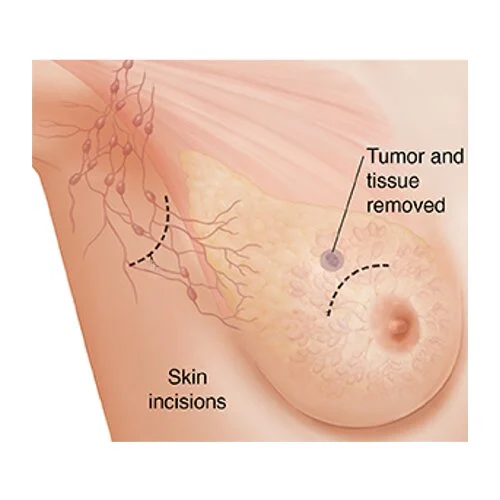 Breast Conservation surgery