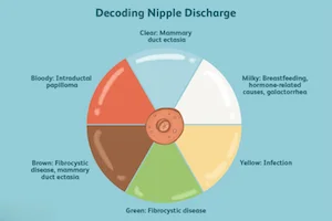 Nipple Discharge